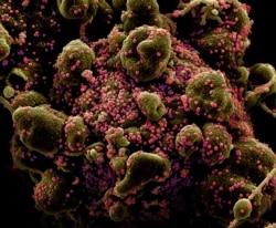 Апоптотическая клетка (зеленовато-коричневого цвета), сильно зараженная вирусом SARS-COV-2