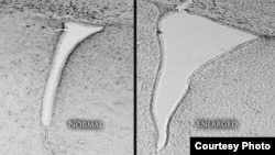 A mouse brain that was exposed to polluted air shows an enlarged lateral ventricle (right) compared with a mouse whose air was clean and filtered. Enlarged lateral ventricles are associated in humans with autism and schizophrenia. (University of Rochester Medical Center)