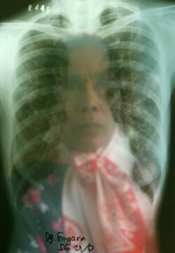Seorang perempuan penderita Tuberkulosis (TBC) melihat hasil rontgennya di sebuah rumah sakit TBC di Makassar, Sulawesi Selatan, 23 Oktober 2009. (Foto: REUTERS/Yusuf Ahmad)