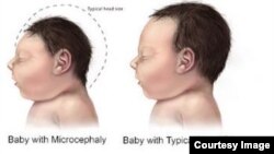 Zika tem sido associado a microcefalia