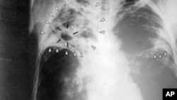 Tuberculose Multi-resistente