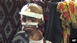 A malnourished child from southern Somalia at the Banadir hospital in Mogadishu, August 25, 2011