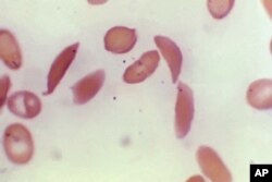 FILE - FILE - This microscope photo provided on Oct. 25, 2023, by the Centers for Disease Control and Prevention shows crescent-shaped red blood cells from a sickle cell disease patient in 1972.