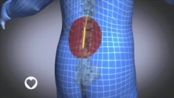 MAISHA NA AFYA EP 55: Tatizo la mgongo wazi