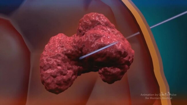 Doctors Unveil Potential New Tool in Fight Against Brain Cancer