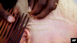 African rights court orders compensation for Tanzania’s albinos