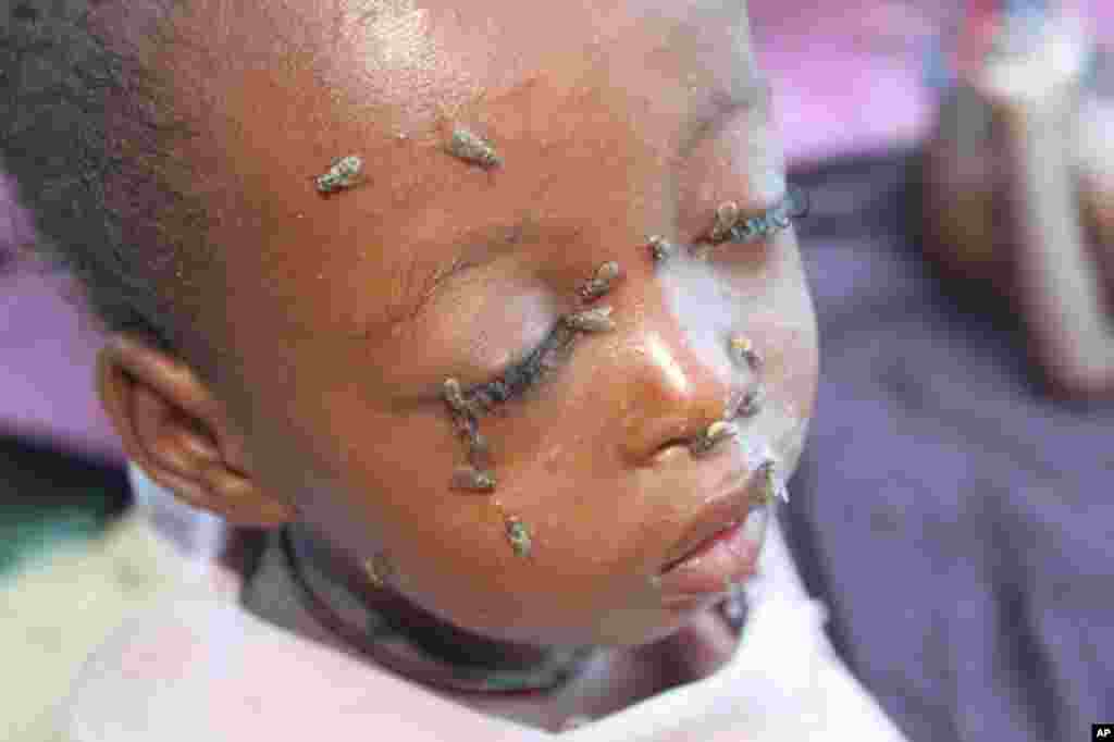 This Somali child is suffering from measles and malnutrition. (VOA - P. Heinlein)