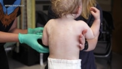 Eczema Treatment During Infancy Helps Prevent Asthma, Allergies