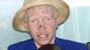 Liberia Opens Center For Albinos