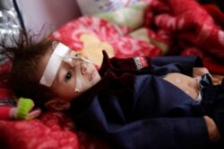 FILE - A malnourished boy lies in a bed waiting to receive treatment at a feeding center at Al-Sabeen hospital in Sanaa, Yemen, Nov. 23, 2019.