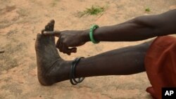 FILE - A woman points to her toe from where, she said, three worms emerged in 2009 when she was infected with Guinea worm in her town of Terekeka, South Sudan, Oct. 4, 2017.