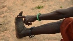 FILE - A woman points to her toe from where, she said, three worms emerged in 2009 when she was infected with Guinea worm in her town of Terekeka, South Sudan, Oct. 4, 2017.