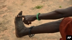 FILE - A woman points to her toe from where, she said, three worms emerged in 2009 when she was infected with Guinea worm in her town of Terekeka, South Sudan, Oct. 4, 2017.