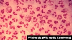 Một mẫu mủ từ đầu dương vật nhìn dưới kính hiển vi, cho thấy các tế bào đa nhân trung tính (có nhiều thùy, có nhiệm vụ tiêu diệt vi khuẩn), trên hình vi khuẩn bệnh lậu hiện lên như những đốm nhỏ gồm hai đốm dính liền nhau ở trong lòng của tế bào. (Ảnh trên trang Wikipedia).