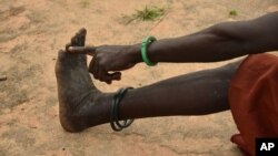 Seorang perempuan menunjukkan jari kakinya yang menurutnya mengeluarkan 3 ekor cacing saat ia menderita penyakit 'Cacing Guinea', di Terekeka, Sudan Selatan (foto: dok). 