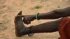 FILE - A woman points to her toe from where, she said, three worms emerged in 2009 when she was infected with Guinea worm in her town of Terekeka, South Sudan, Oct. 4, 2017.