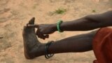 FILE - A woman points to her toe from where, she said, three worms emerged in 2009 when she was infected with Guinea worm in her town of Terekeka, South Sudan, Oct. 4, 2017.