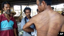 Raimundo Moreira, 28, displays scars he said he received from two days of beatings and torture by Indonesian special forces in Dili. (File)