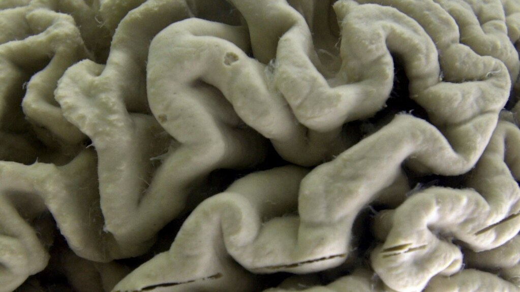 Study: Gene May Cause Alzheimer’s in Some Cases