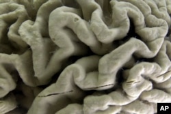 FILE - A section of a human brain with Alzheimer's disease is displayed at the Museum of Neuroanatomy at the University at Buffalo, in Buffalo, N.Y., Oct. 7, 2003. (AP Photo/David Duprey, File)