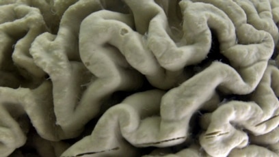 Study: Gene May Cause Alzheimer’s in Some Cases