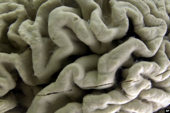 FILE - A section of a human brain with Alzheimer's disease is displayed at the Museum of Neuroanatomy at the University at Buffalo, in Buffalo, N.Y., Oct. 7, 2003. (AP Photo/David Duprey, File)