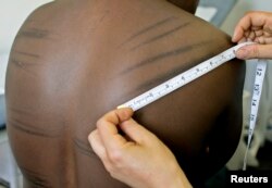 FILE - A torture sufferer from Uganda is examined by a doctor at the headquarters of Freedom From Torture, formerly known as the Medical Foundation for the Care of Victims of Torture, in London.