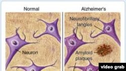 Protein beta amyloid, hình phải.