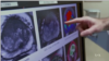 MRI Hindari Biopsi Prostat