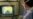 Doctors Debate Benefits, Risks of Virtual Colonoscopy