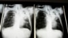 Peneliti Temukan Cara Baru Deteksi Penyakit TB