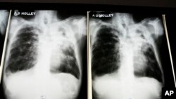 Images of the lungs of a tuberculosis patient. Simple TB is easy to treat, but the medication must be taken in specific combinations for six months to completely wipe out the bacteria.