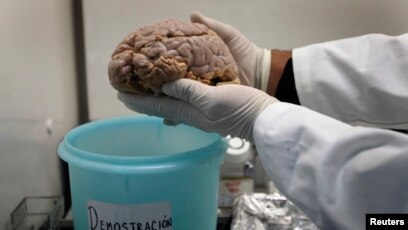 Percee Majeure Dans Les Recherches Sur La Maladie D Alzheimer