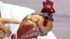 CDC: 1 in 4 US Deaths From Heart Disease Preventable