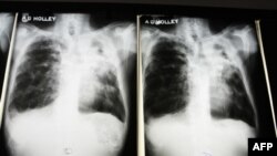 Rentgenski snimak pluća zaraženih tuberkolozom