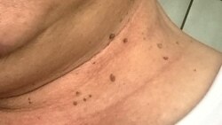 Hỏi đáp Y học: Thịt dư da (Skin tags)