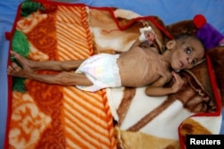 One-year-old Fatima Abdullah Hassan, who suffers from severe malnutrition, lies in bed at a malnutrition treatment center in the Red Sea port city of Hodeida, Yemen.