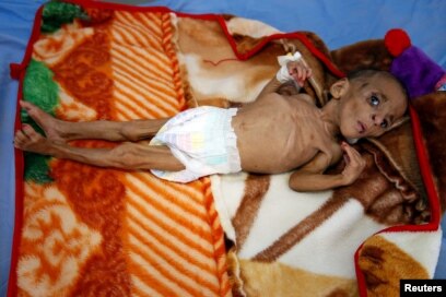 Fatima Abdullah Hassan, 1 tuổi và bị suy dinh dưỡng nghiêm trọng, nằm trong một trung tâm điều trị ở thành phố cảng Hodeida ven Biển Đỏ, Yemen.