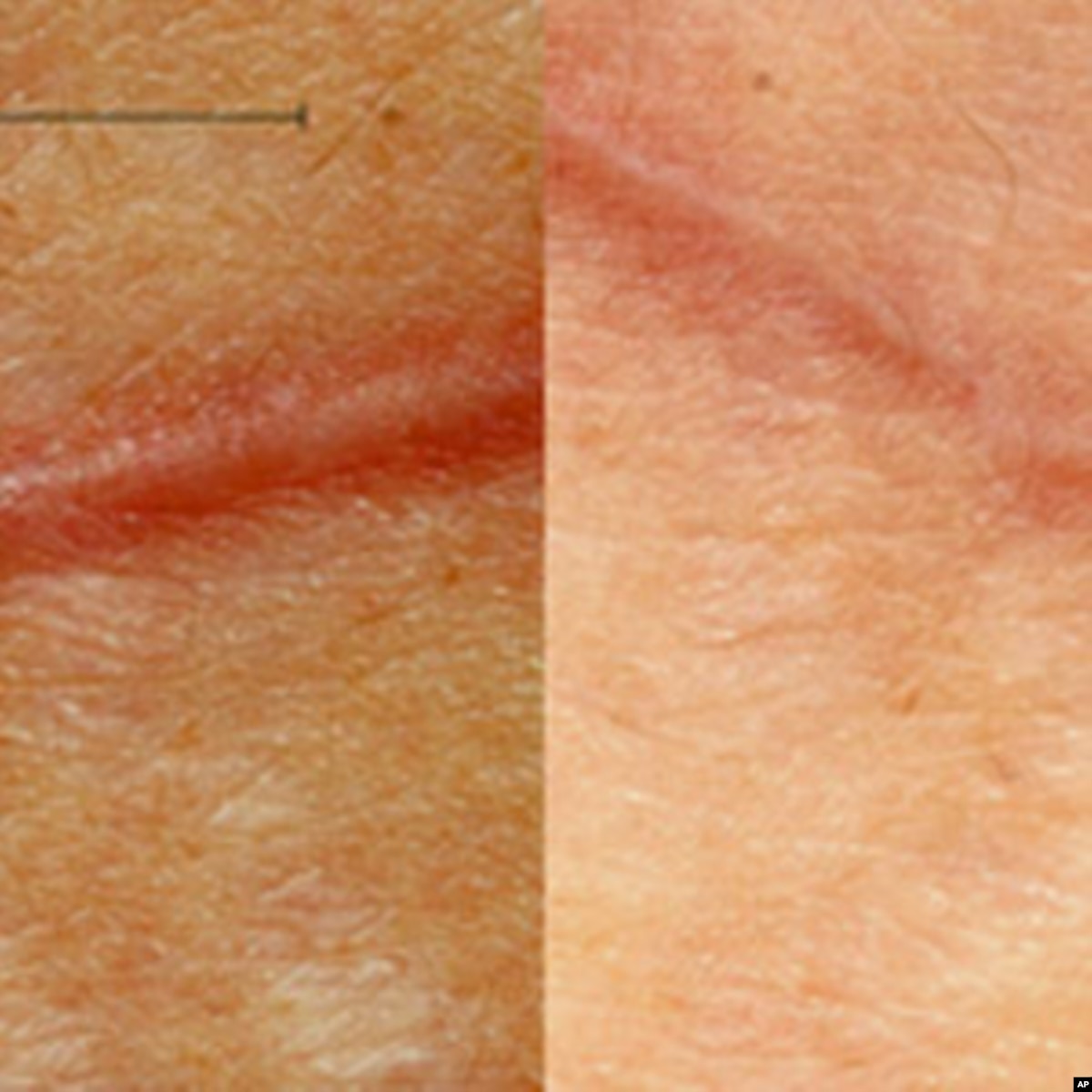 New Bandage Designed to Reduce Surgical Scars