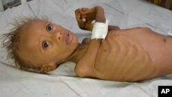 FILE - In this photo taken Sept. 9, 2016, Salem, 5, who suffers from malnutrition, lies on a bed at a hospital in the port city of Hodeidah, southwest of Sana'a, Yemen. 