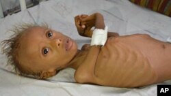 FILE - In this photo taken Sept. 9, 2016, Salem, 5, who suffers from malnutrition, lies on a bed at a hospital in the port city of Hodeidah, southwest of Sana'a, Yemen. 