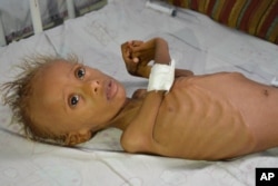 FILE - In this photo taken Sept. 9, 2016, Salem, 5, who suffers from malnutrition, lies on a bed at a hospital in the port city of Hodeidah, southwest of Sanaa, Yemen.