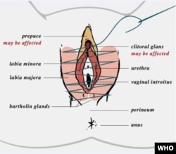 A WHO clinical handbook explains that, in Type 3 female circumcision, the vaginal opening is narrowed by cutting and stitching together the labia minora or majora – with or without removing the clitoral glans and pupace.
