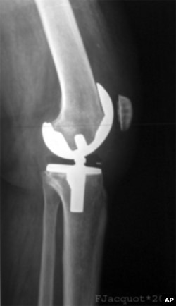 This x-ray shows shows an artificial knee joint, but now scientists are exploring regenerating damaged joints using a patient's own stem cells.