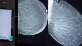 Detecting and treating breast cancer