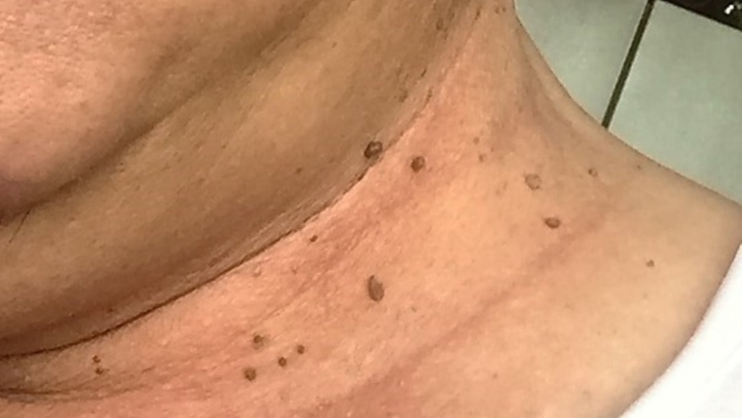 Định Nghĩa Skin Tag