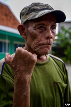 Seorang penyintas kusta, Jumangun, memperlihatkan tangannya yang cacat di "kampung kusta" Tangerang, 18 Januari 2023 ini. (BAY ISMOYO / AFP)