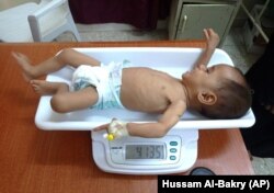A malnourished boy is placed on a scale at the Hays Rural Hospital in Hodeida, Yemen, Tuesday, Oct. 11, 2022. (AP Photo/Hussam Al-Bakry)