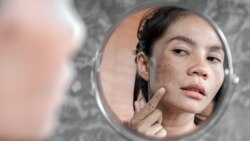 Nám và tàn nhang: Cách phòng và trị