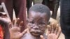 Monkeypox Strikes in Congo